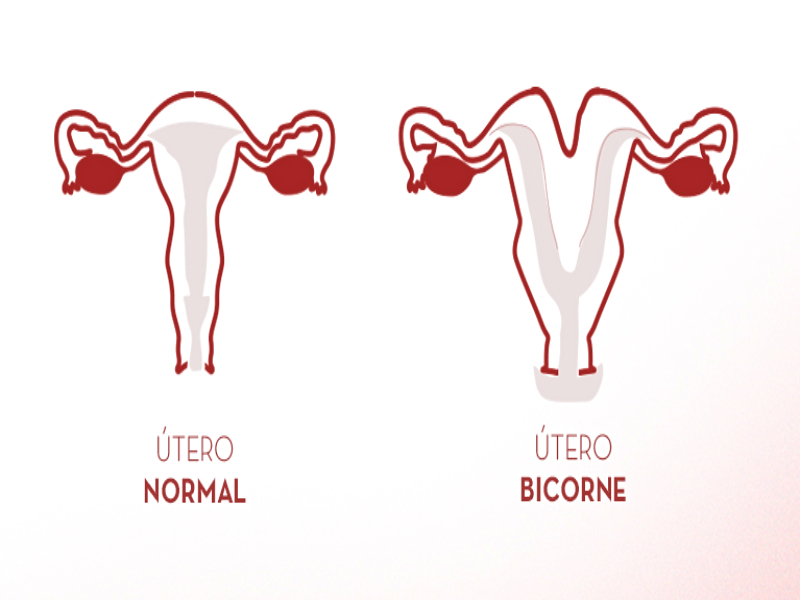 Diferencia entre útero normal y bicorne